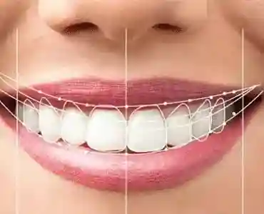 افزایش طول عمر ایمپلنت دندان