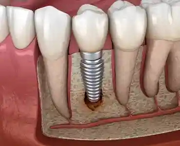 علت کج شدن ایمپلنت دندان