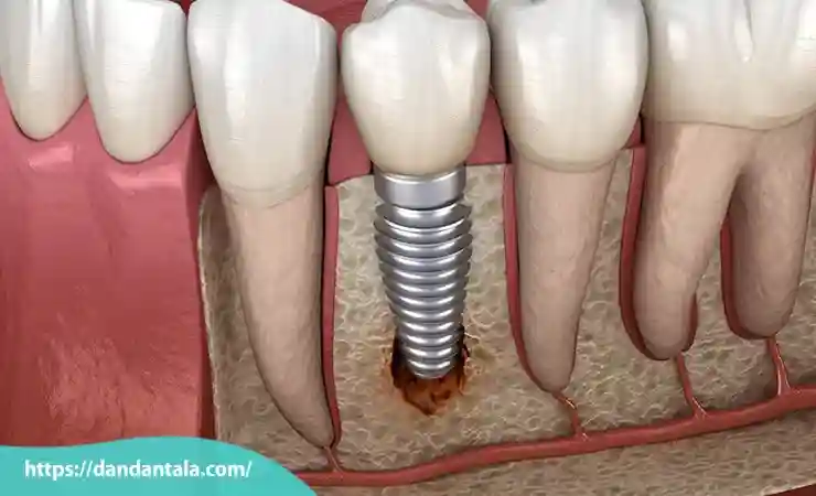 علت کج شدن ایمپلنت دندان