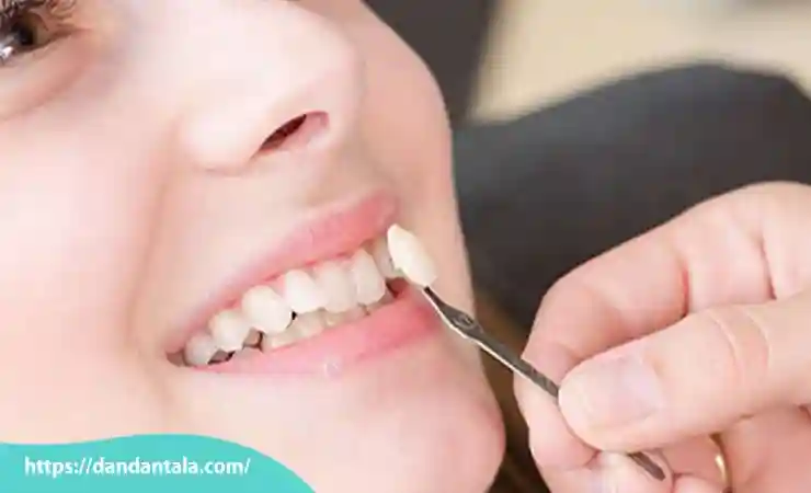 تفاوت کامپوزیت ونیر و کامپوزیت سرامیکی