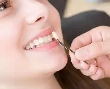 تفاوت کامپوزیت ونیر و کامپوزیت سرامیکی
