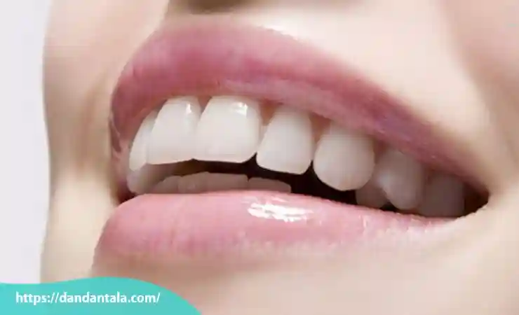 معایب کامپوزیت دندان