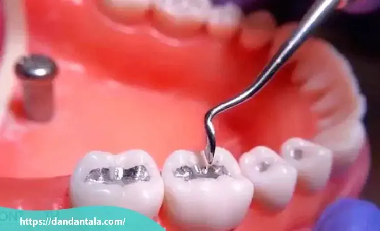 ترمیم با آمالگام
