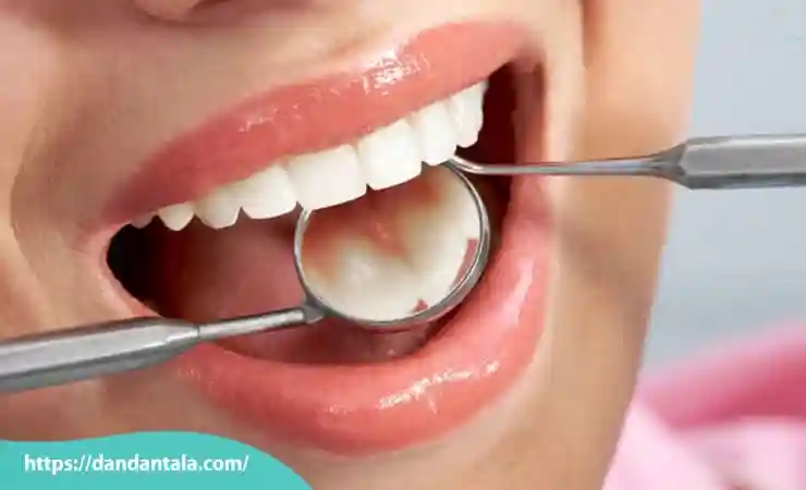 لمینت بهتر است یا کامپوزیت؟