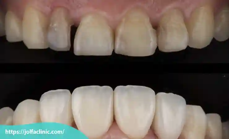 ترک خوردگی و شکستگی کامپوزیت