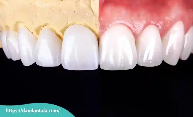تفاوت کامپوزیت ونیر و کامپوزیت سرامیکی کدام یک بهتر است؟