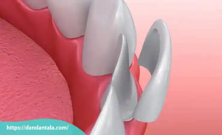 معایب کامپوزیت ونیر