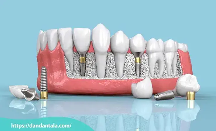 ایمپلنت های ساخت آلمان