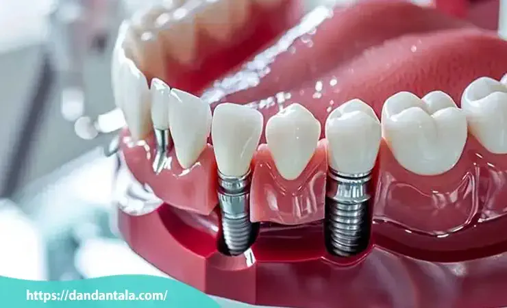 ایمپلنت های ساخت کره جنوبی