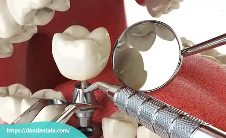 رعایت بهداشت دقیق دهان و دندان