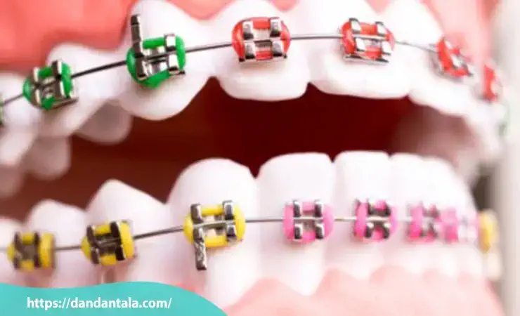 بهترین رنگ ارتودنسی