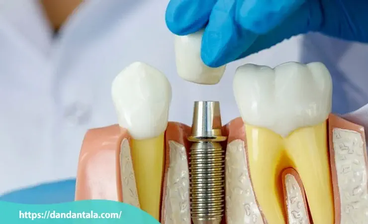 چه عواملی باعث افزایش طول عمر ایمپلنت می شوند؟