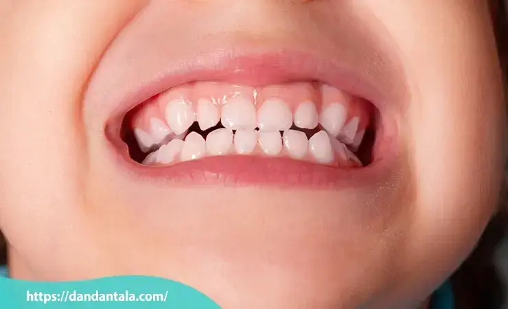 چرا دندان شیری نیاز به روکش پیدا می کند؟