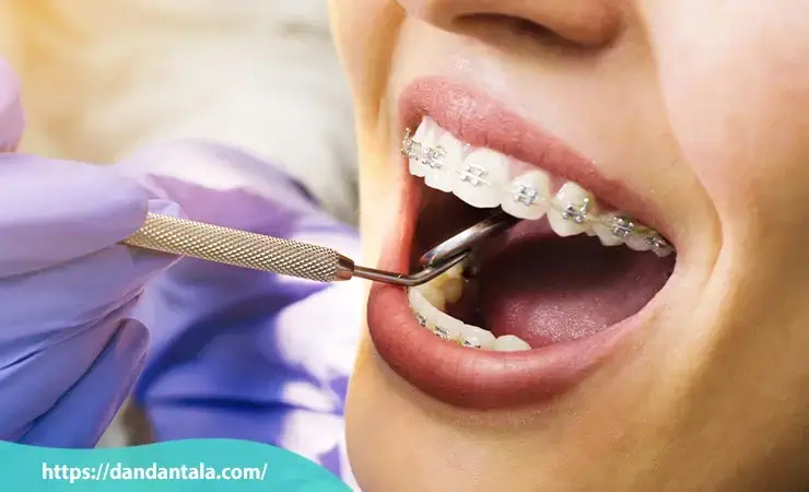 نحوه انتخاب رنگ ارتودنسی