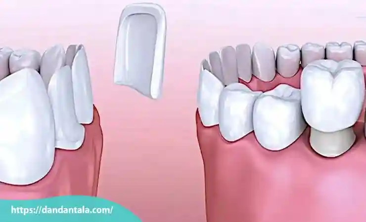 فرق لمینت و کامپوزیت دندان کدام یک بهتر است؟