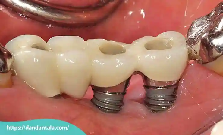تثبیت ایمپلنت با استفاده از پیچ ها یا ابزارهای کمکی