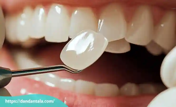 مزایا و معایب لمینت و کامپوزیت دندان