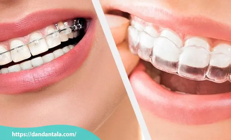ارتودنسی دندان برای چه کسانی است؟