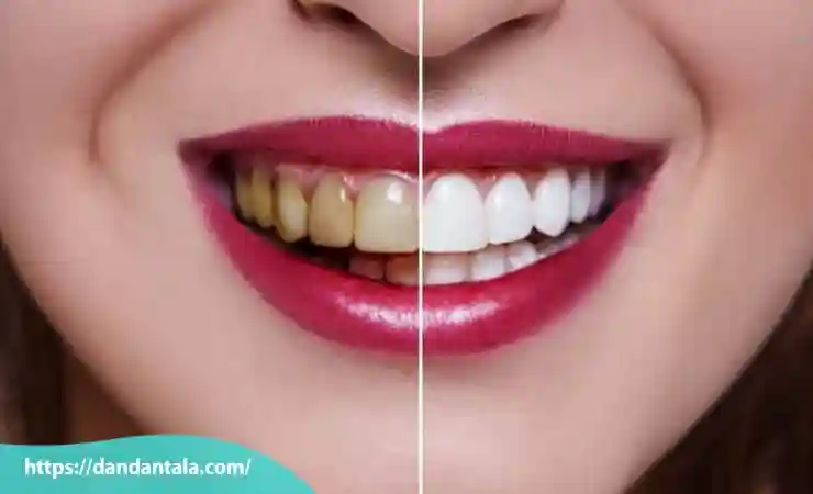 مراقبت های بعد از بلیچینگ دندان
