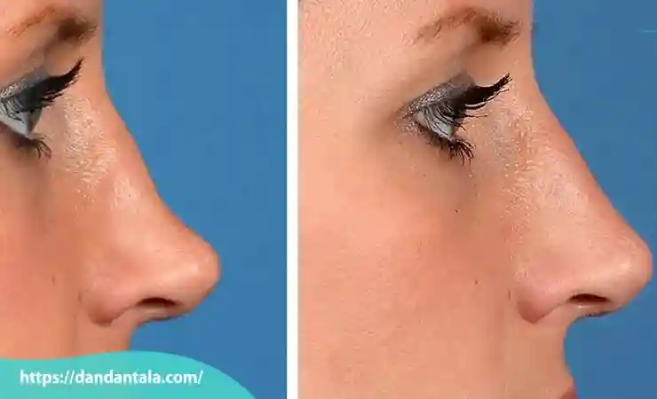 مراقبت های بعد از تزریق فیلر بینی