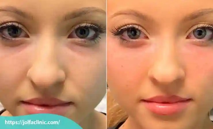 مراقبت های بعد از ترزیق ژل گونه