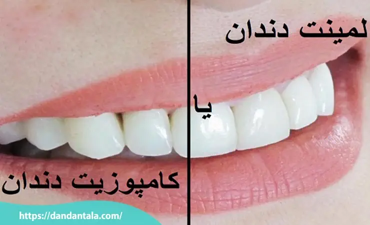 لمینت سرامیکی یا کامپوزیتی؟