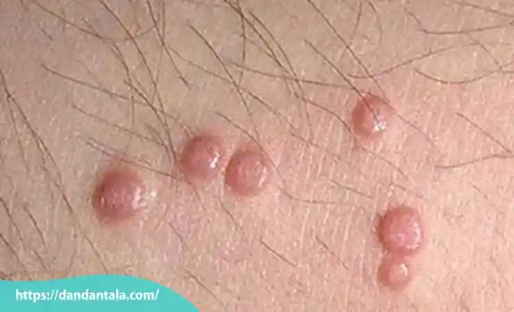 هزینه لیزر زگیل تناسلی