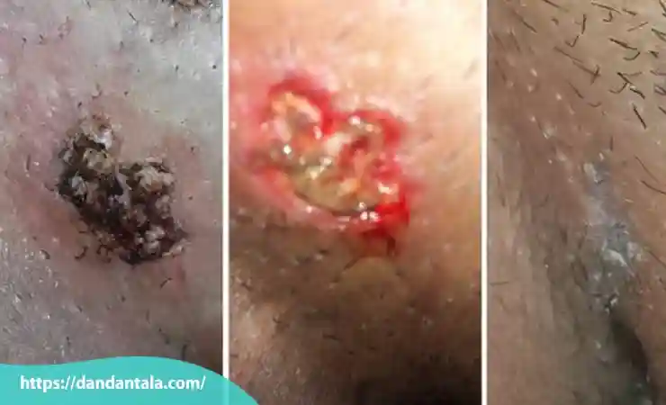 نحوه لیزر زگیل تناسلی