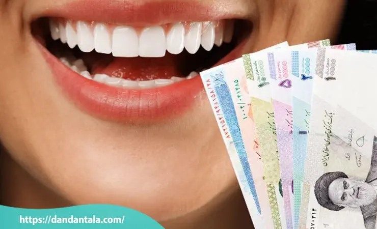 قیمت لمینت سرامیکی دندان