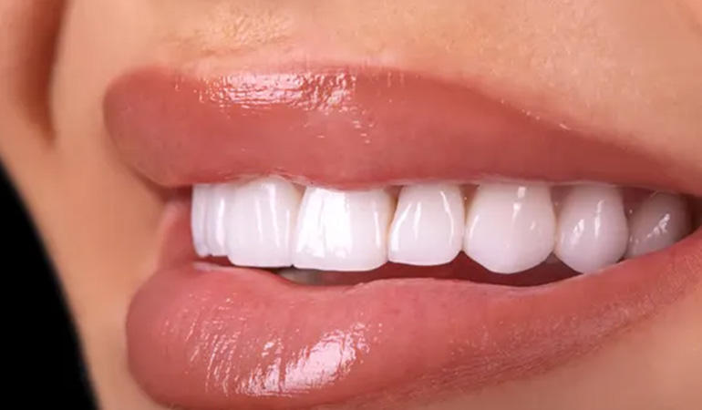 لمینت سرامیکی دندان