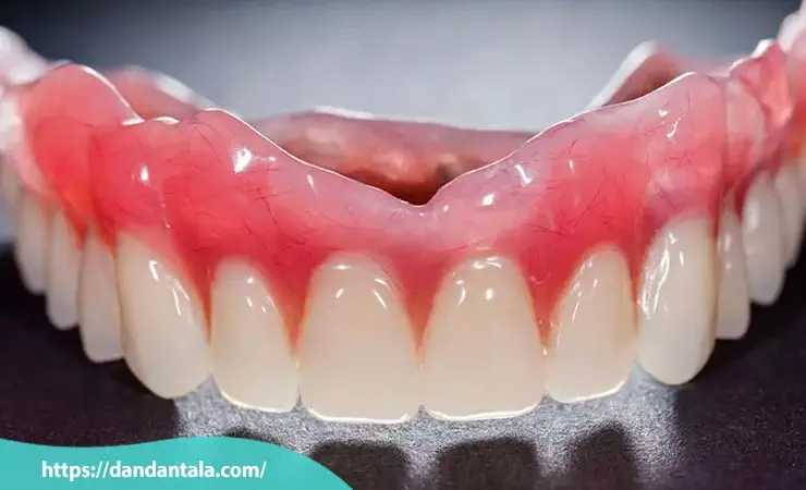 قیمت پروتز دندان تکی