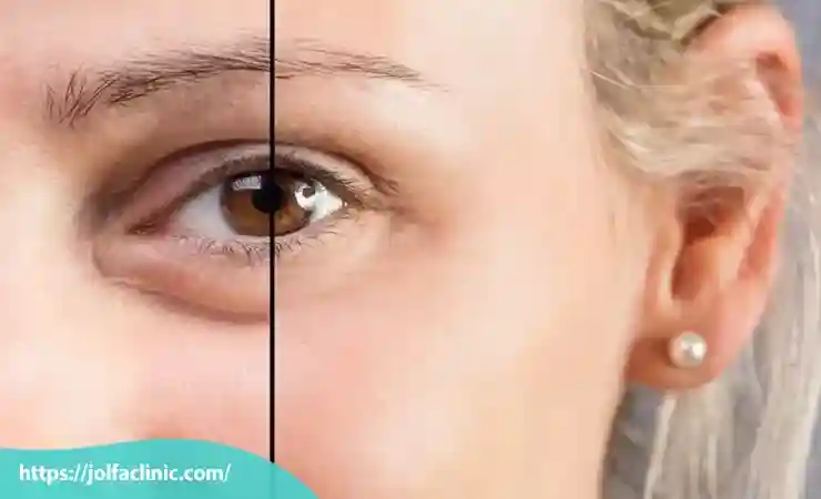 آیا فیلر زیر چشم باعث کوچک شدن چشم می شود؟