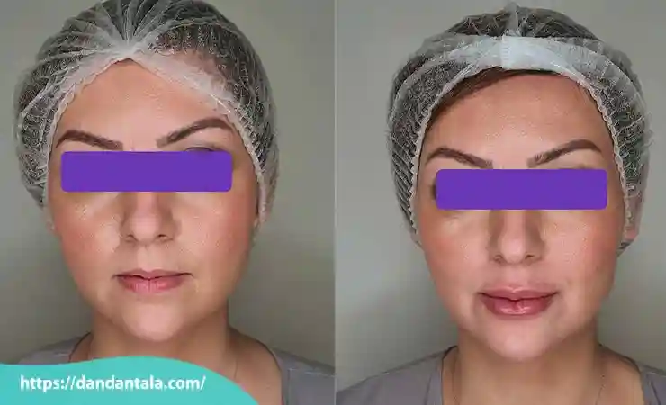 نحوی زاویه سازی فک با تزریق ژل