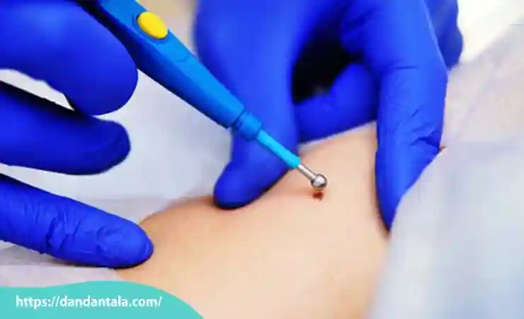 نحوه لیزر زگیل تناسلی