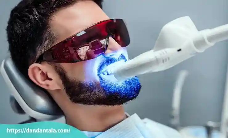 بلیچینگ دندان در مطب