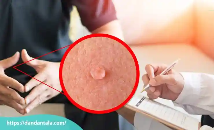 عوارض لیزر زگیل تناسلی