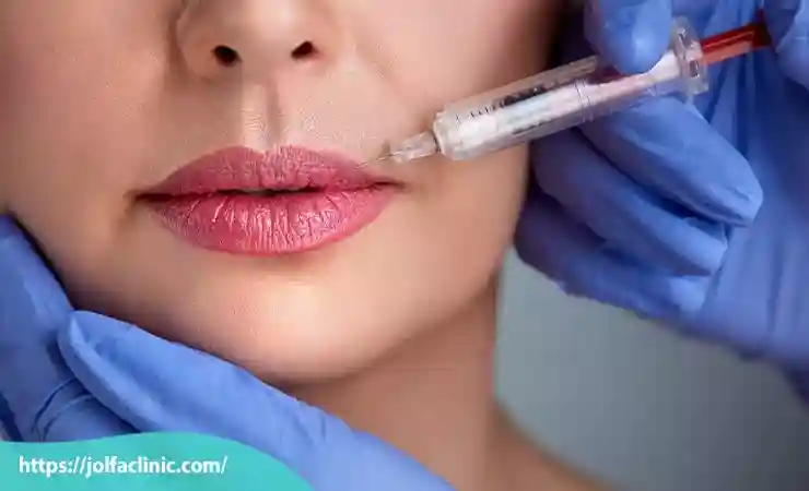 مراحل تزریق ژل لب
