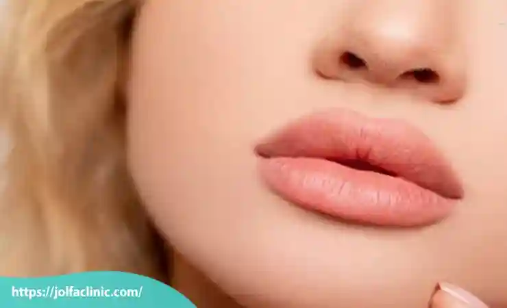 تزریق ژل لب طبیعی