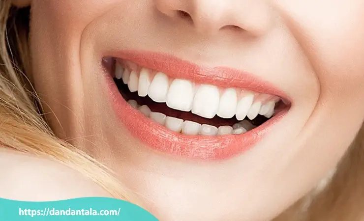 لمینت سرامیکی پرس شده