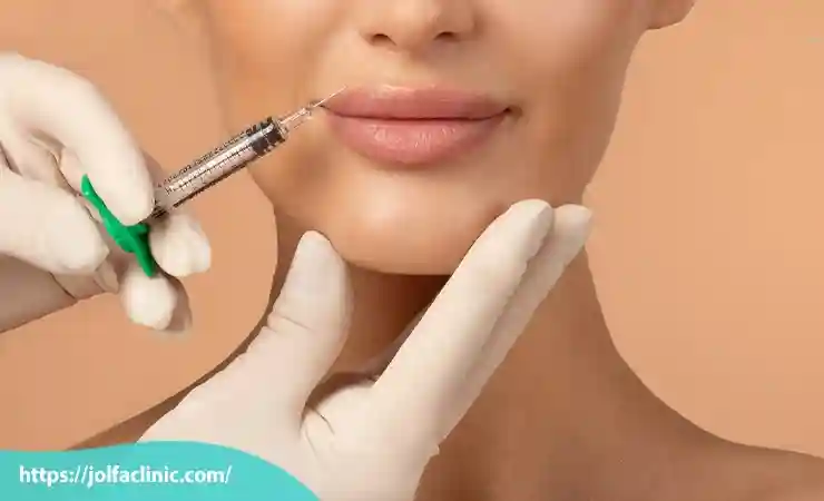 تزریق ژل لب روسی