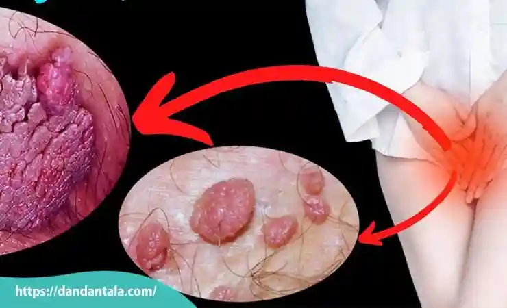 مزایای لیزر زگیل تناسلی