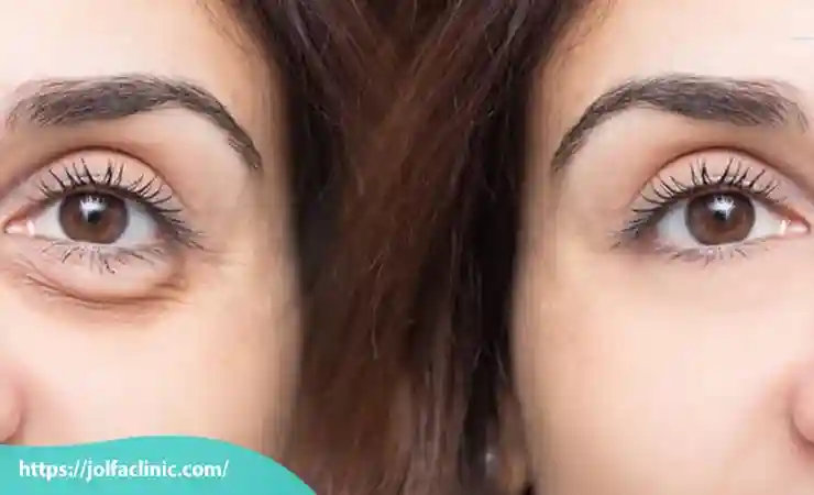 مراقبت قبل از تزریق فیلر زیر چشم